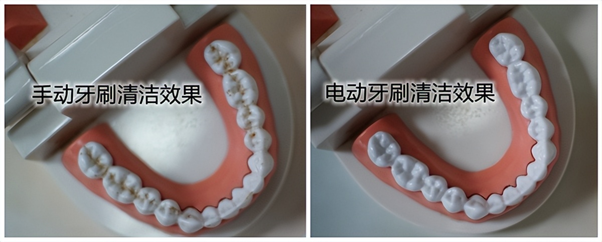 长期使用电动牙刷的危害弊端,老年人用电动牙刷的危害