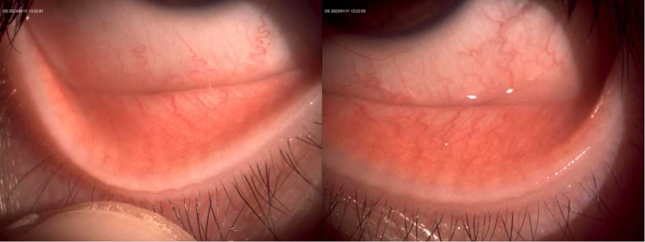 新冠引起的眼睛充血怎么治疗,新冠导致眼睛充血用什么药