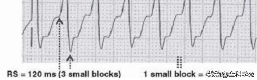 心电图上表现为宽qrs波,心电图中qrs是代表心动过速吗