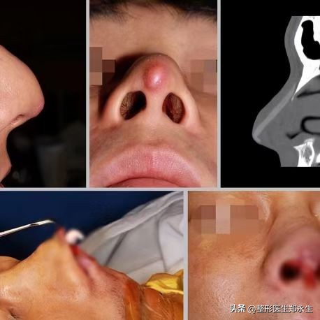 修复隆鼻不满意最佳取出时间,如何进行隆鼻失败修复