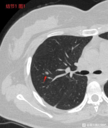 磨玻璃结节生长在右下方,磨玻璃结节微浸润靠近肺门