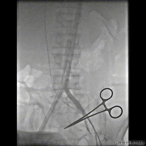 病例回顾与分享,腹膜后血肿介入治疗