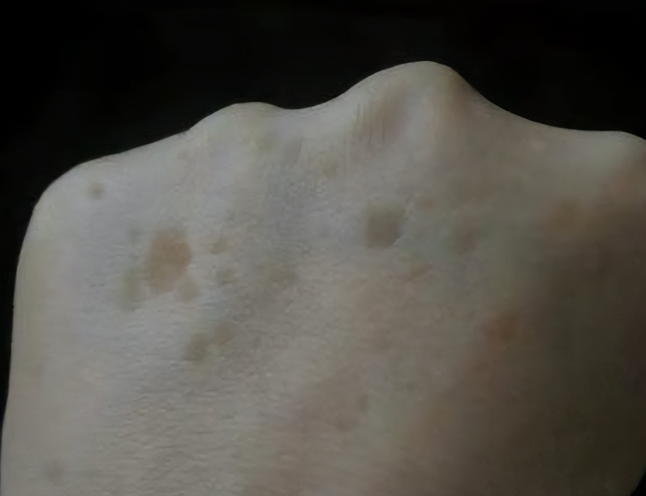 快速消除老年斑的小妙招红霉素,红霉素软膏能去除老年斑吗