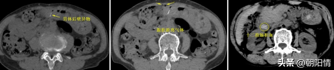消化道异物中医诊断名称,消化道骨性异物