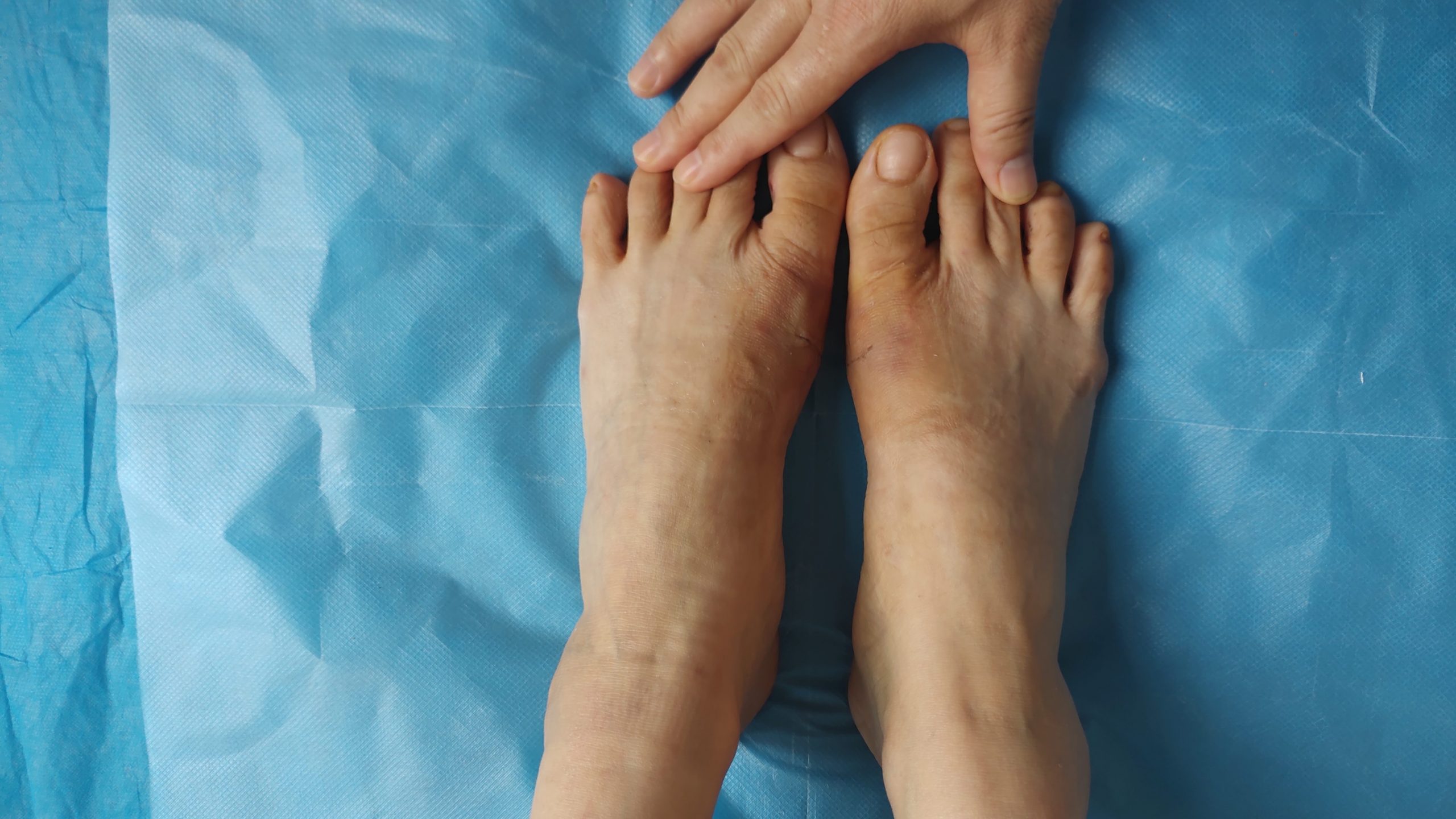 矫正拇外翻一般多少钱一次手术,小女孩一只脚拇外翻怎么矫正最快