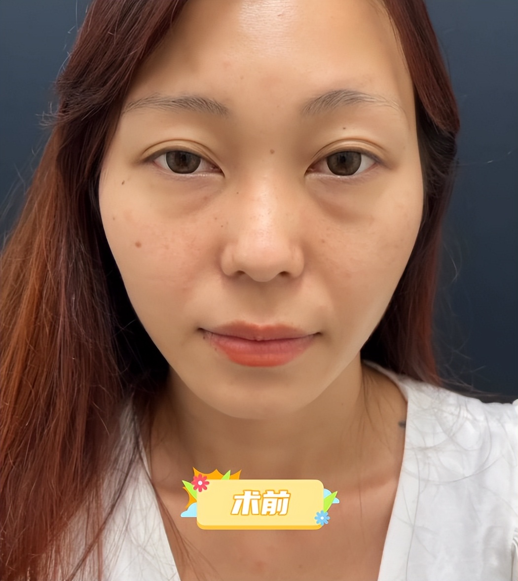 内切去眼袋手术全过程,做了去眼袋手术五天怎么还有眼袋