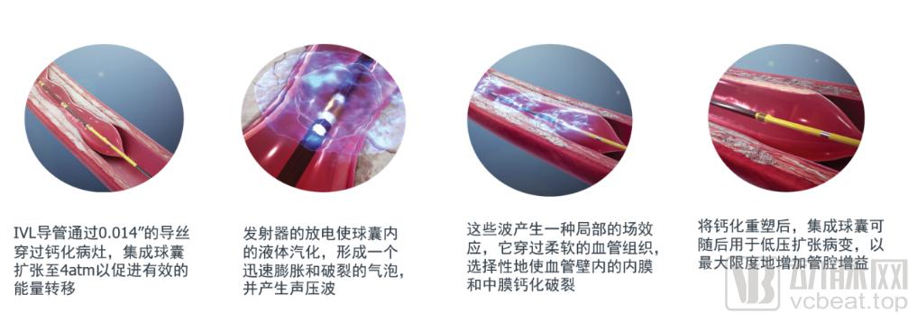 天津oct冠脉介入治疗,oct检查为冠心病诊治带来的启示