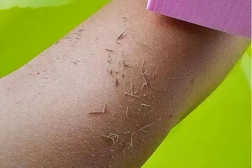 脸上起皮了是怎么回事,脸上起皮是什么原因怎么办