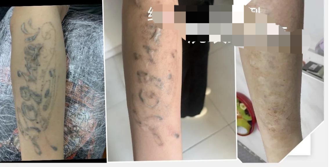 洗纹身真的不是一般人能承受的,洗纹身真的要下很大的决心