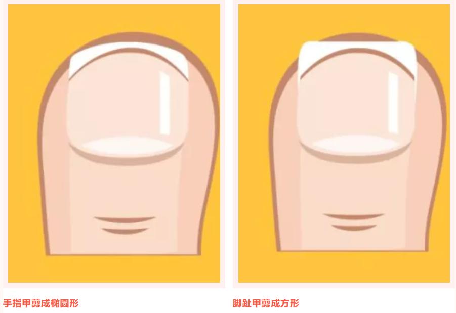 嵌甲危害大，防止有方法