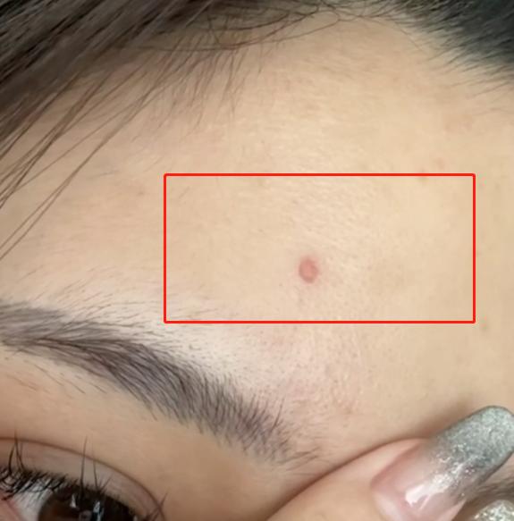 王思聪女友做饭被烫伤，热油溅脸烫出红点，拉衣服露伤被疑博眼球