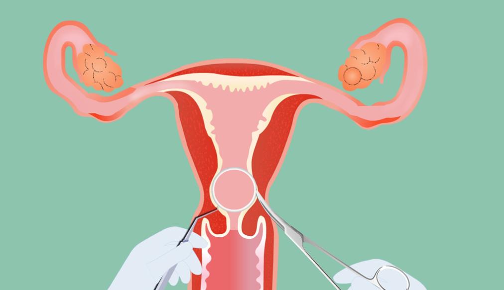 老年女性体内的节育环还用取掉吗,体内节育环几年要取掉