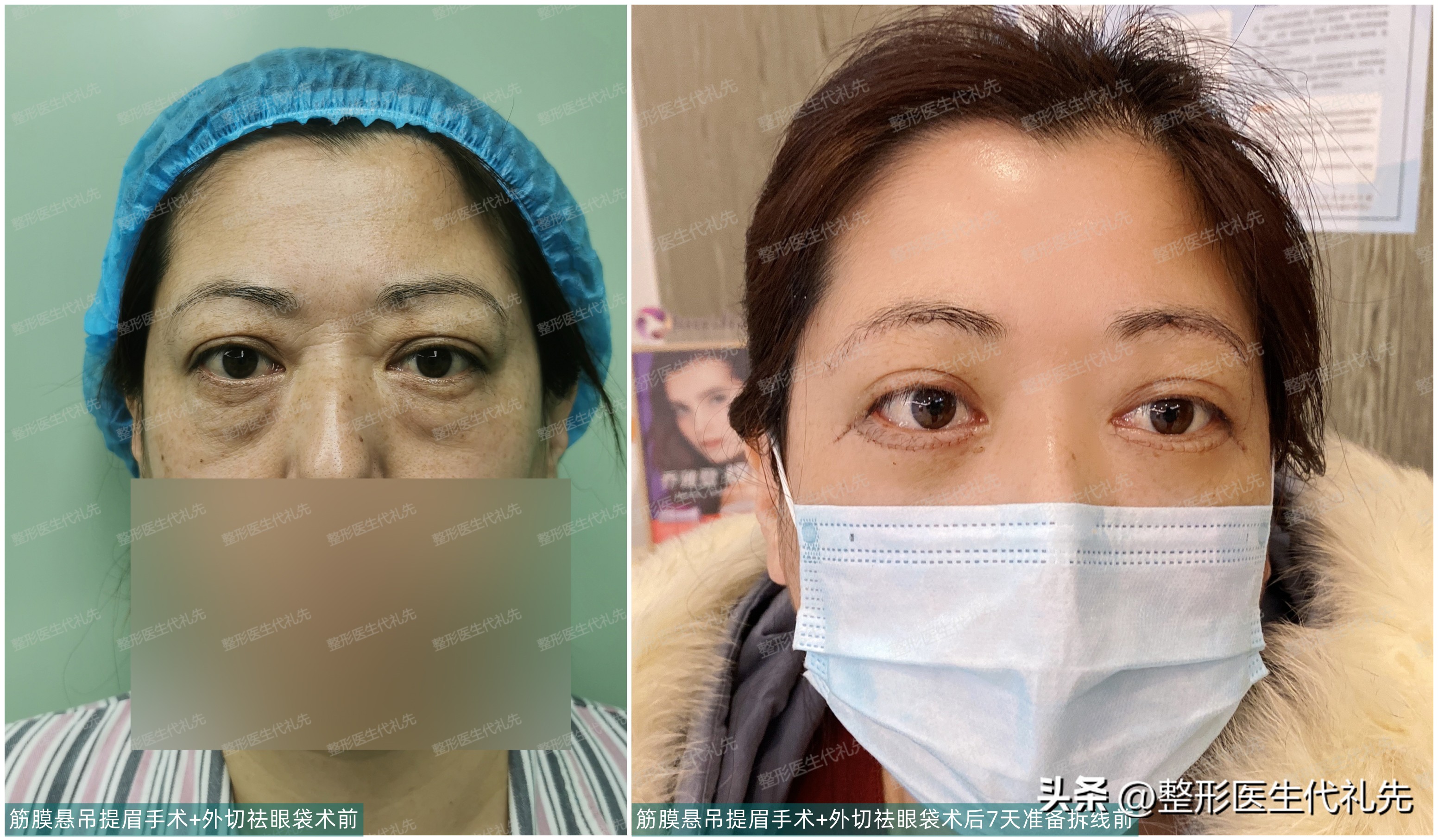 眼袋的原因及消除方法,眼袋是什么原因怎么去除