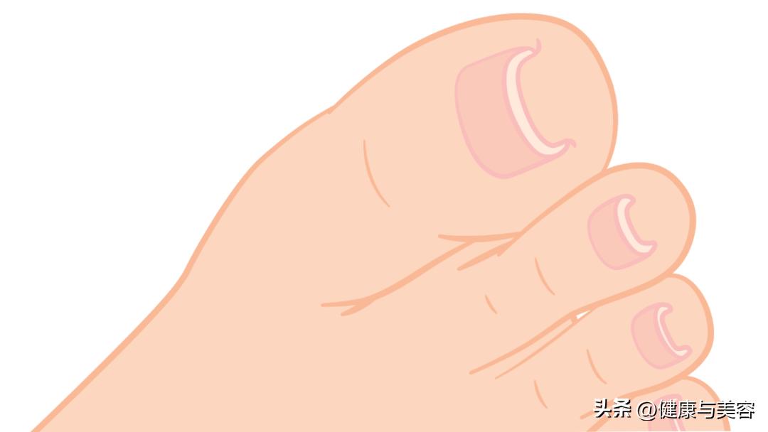 指甲卷曲内卷,指甲卷曲用什么药