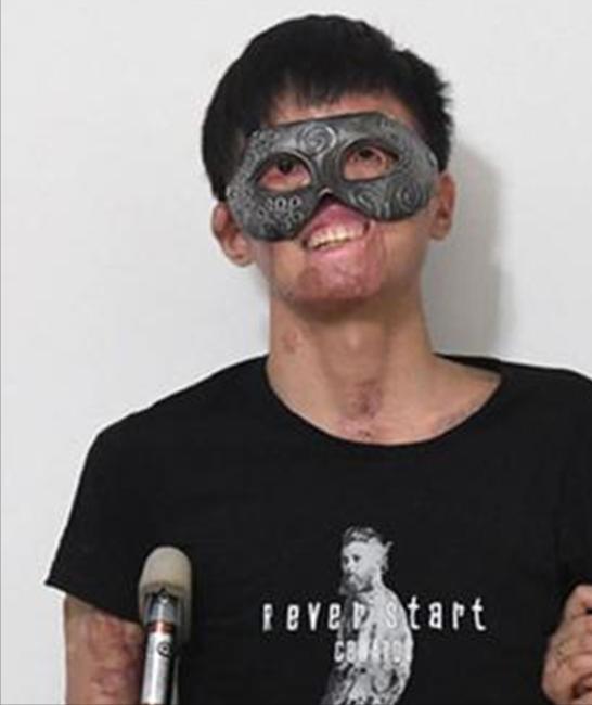 新郎救火时毁容新娘依然嫁给了他,新郎被烧伤新娘前往医院