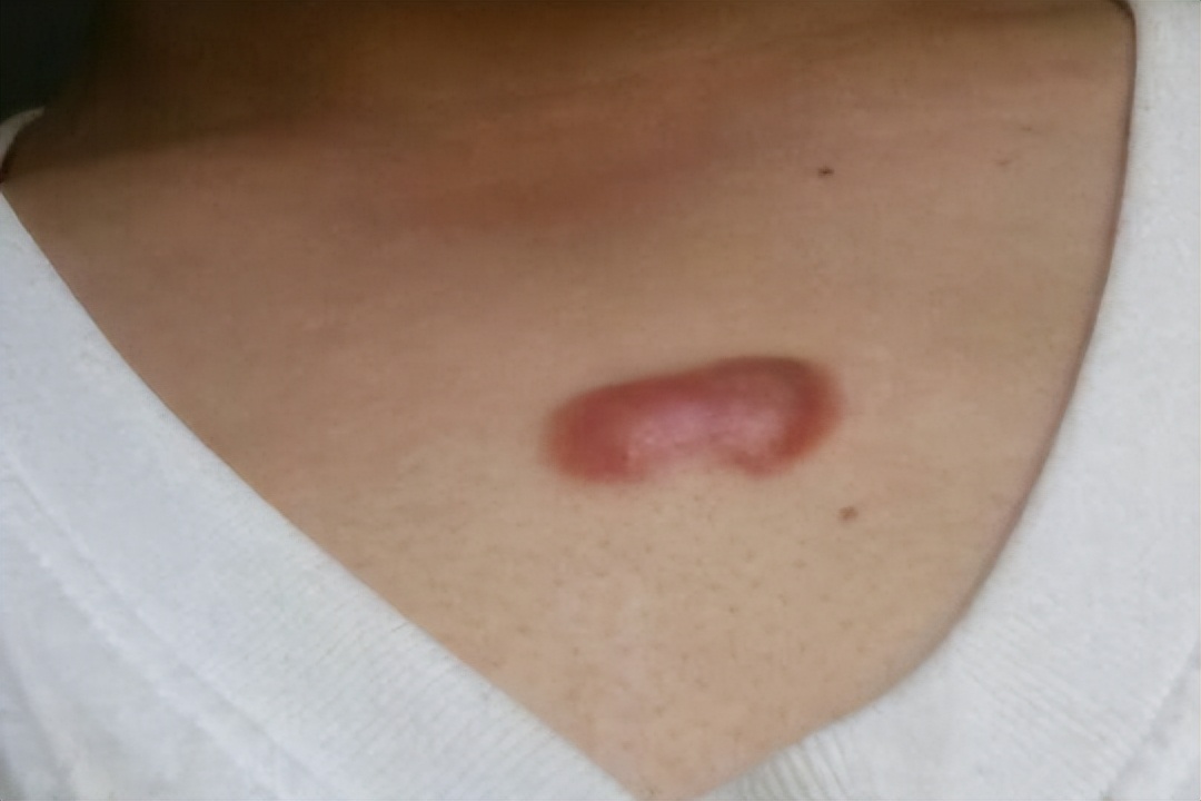 痘痘引起的瘢痕疙瘩怎么治疗,下巴痘痘变成硬疙瘩消除无疤痕