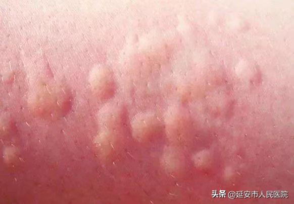 感染新冠皮肤能变好吗,新冠病毒可以通过皮肤感染吗