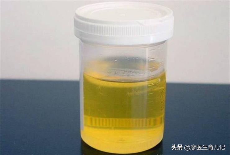 尿液颜色常识图解,孕妇尿液分为哪几种颜色