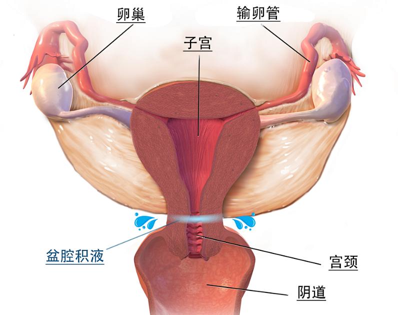 盆腔积液怎么能查出来,盆腔积液如何查出来