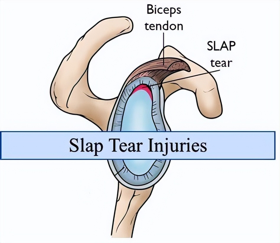 肩关节弹响康复训练视频,肩关节弹响需要吃药吗