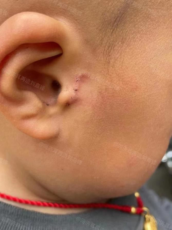 小孩耳朵长了个小肉球,儿童耳朵长了一个小肉球