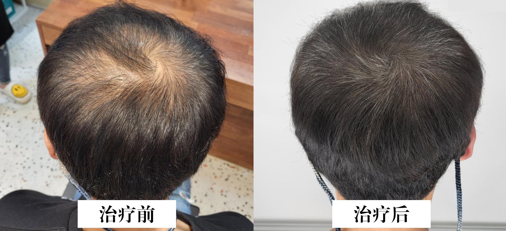 脂溢性脱发一直脱,脂溢性脱发是一直掉么