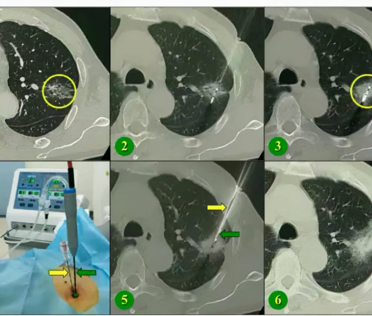 门医科普|肺癌全病程管理，科学防治肺癌系列问答