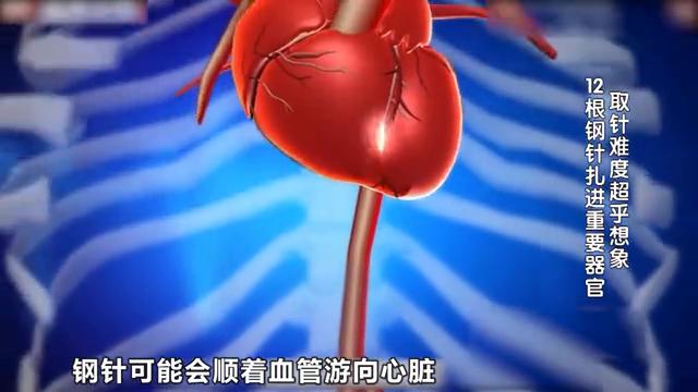 十月女婴体内被扎后续,十个月大女童被扎12根钉