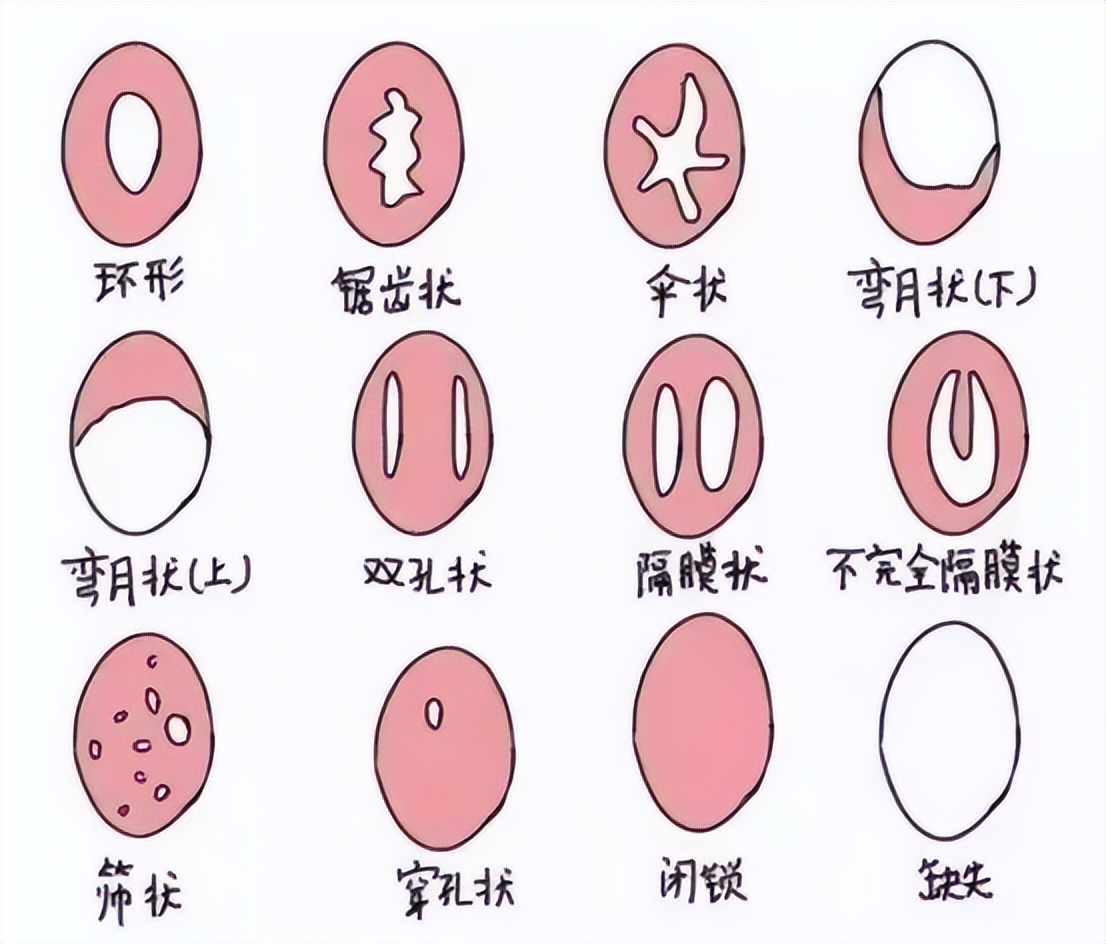 女性第一次发生*行为性**后，真的会“落红”吗？