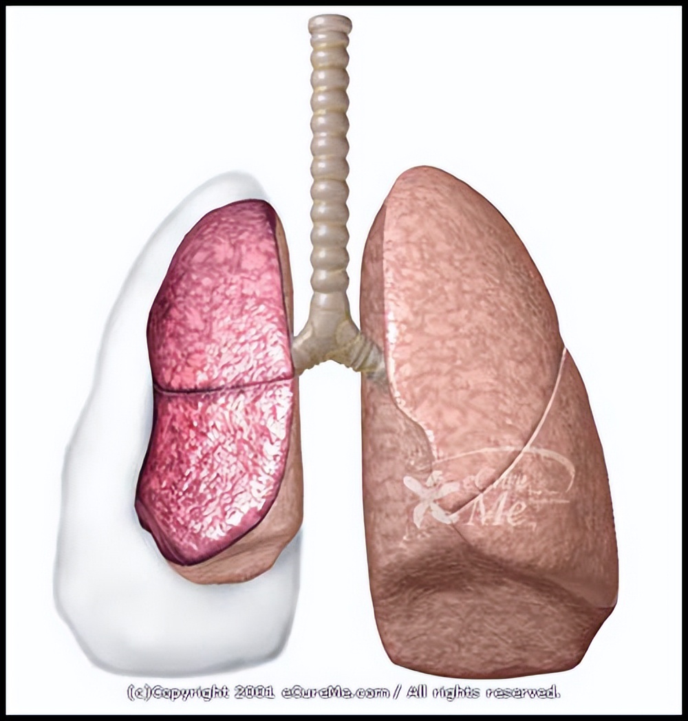 自发性气胸什么卧位,自发性气胸的病史