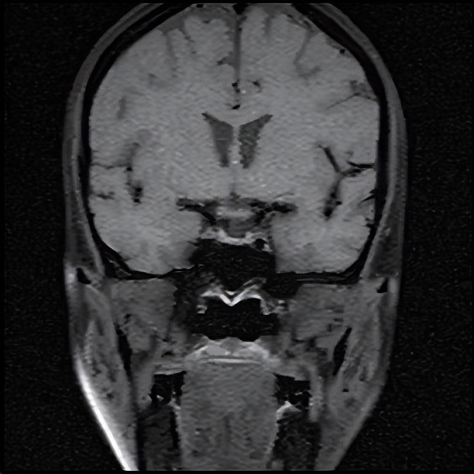 头晕乏力不简单，抽丝剥茧解谜团——粤桂两地医生联手揪出背后“元凶”
