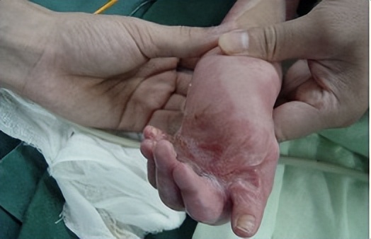 最难愈合的疤痕,无法治愈的疤痕