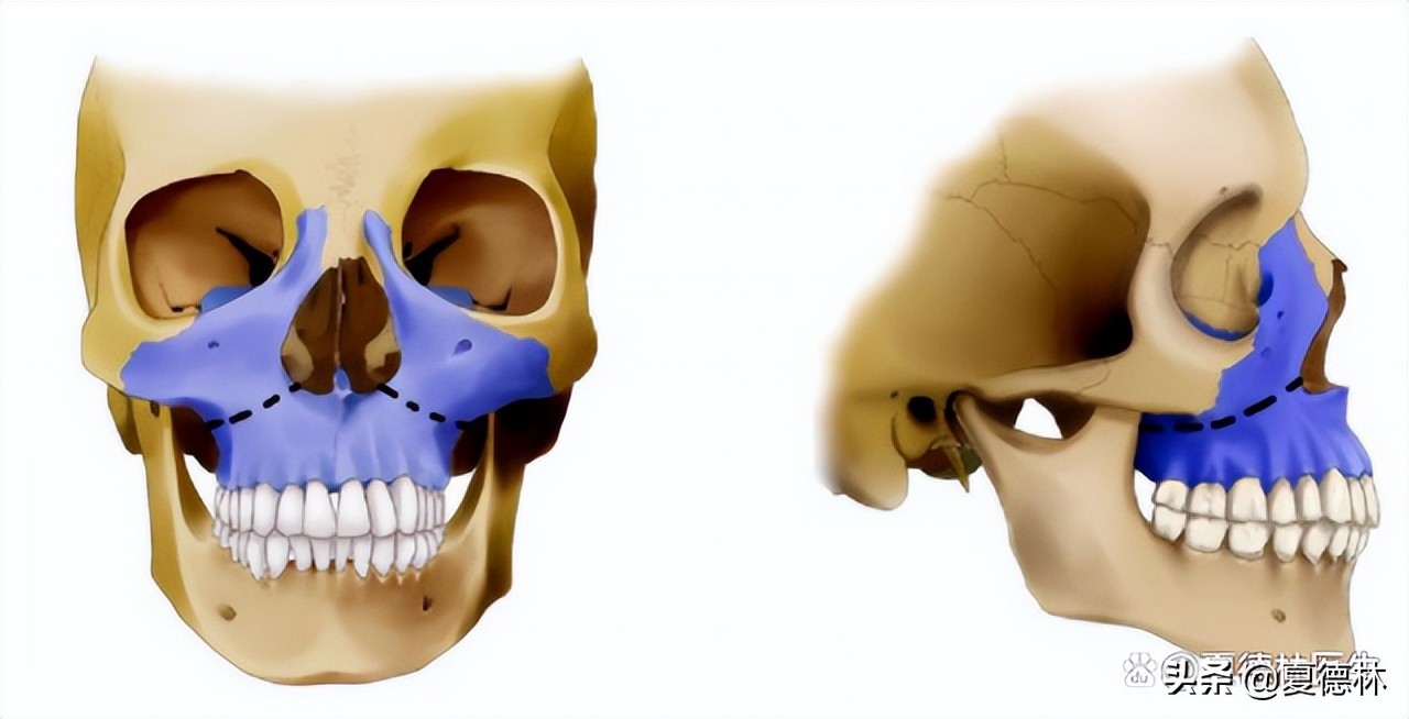 笑起来露牙龈的很难看怎么改善,笑起来不好看露牙龈怎么办