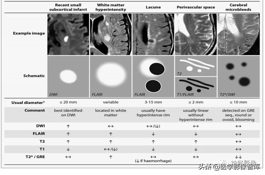 腔隙灶腔梗,陈旧性颅内腔梗灶是什么意思