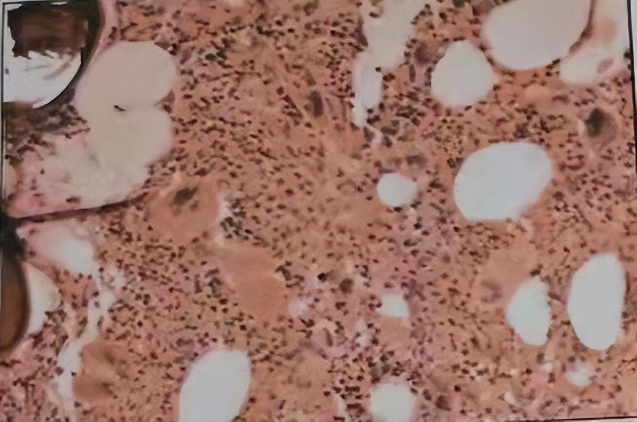 脂肪肝血液异常,脂肪肝的血常规表现