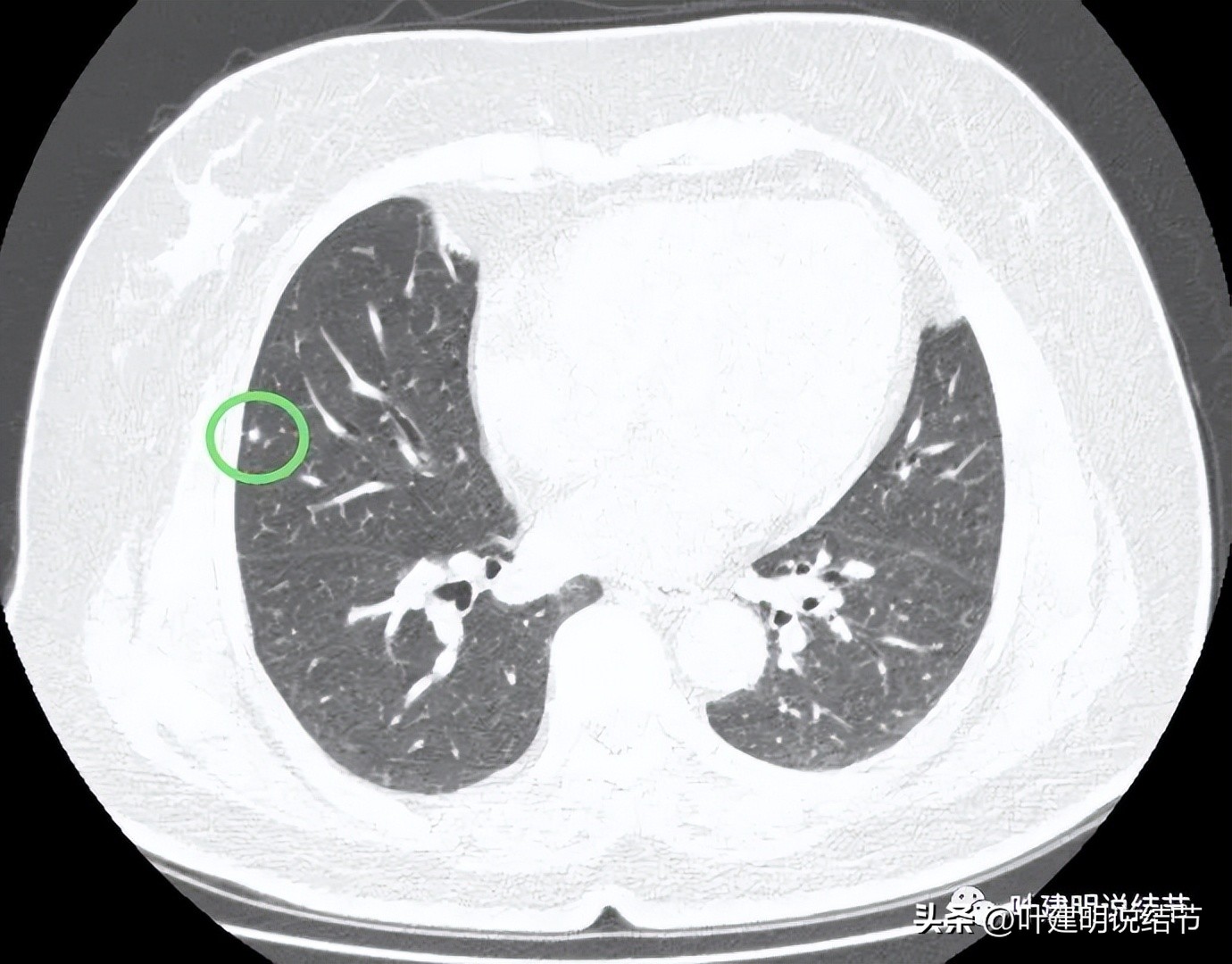 肺结节实性为什么建议抗炎治疗,肺上实性结节抗炎后变成空洞