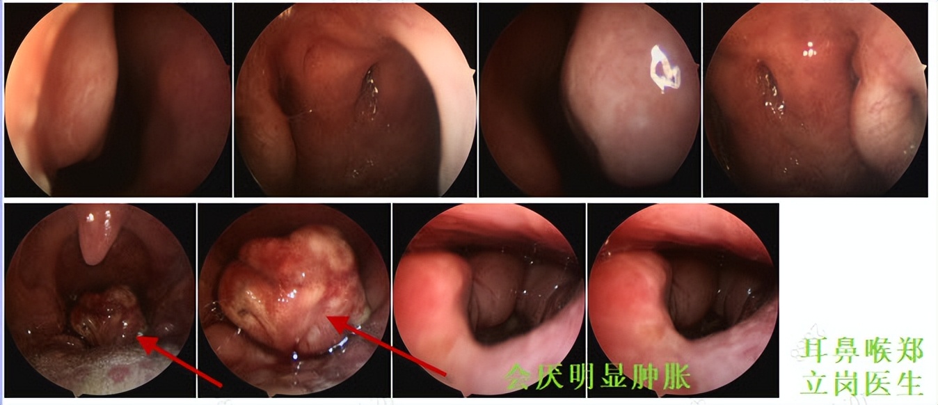 咽喉异物感吞咽困难胃镜检查正常,咽喉不适感越来越强烈怎么治