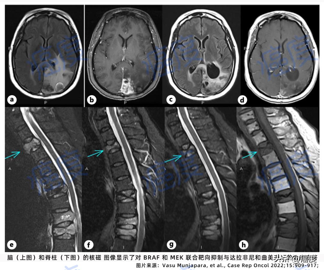 脑瘤braf基因未突变怎么治疗,肿瘤驱动基因BRAF