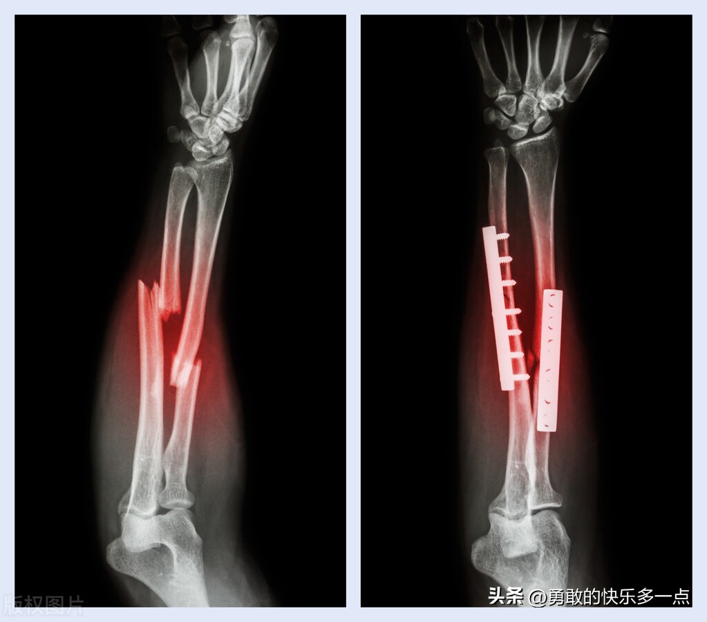 骨折不愈合的10个征兆,骨折愈合恢复视频