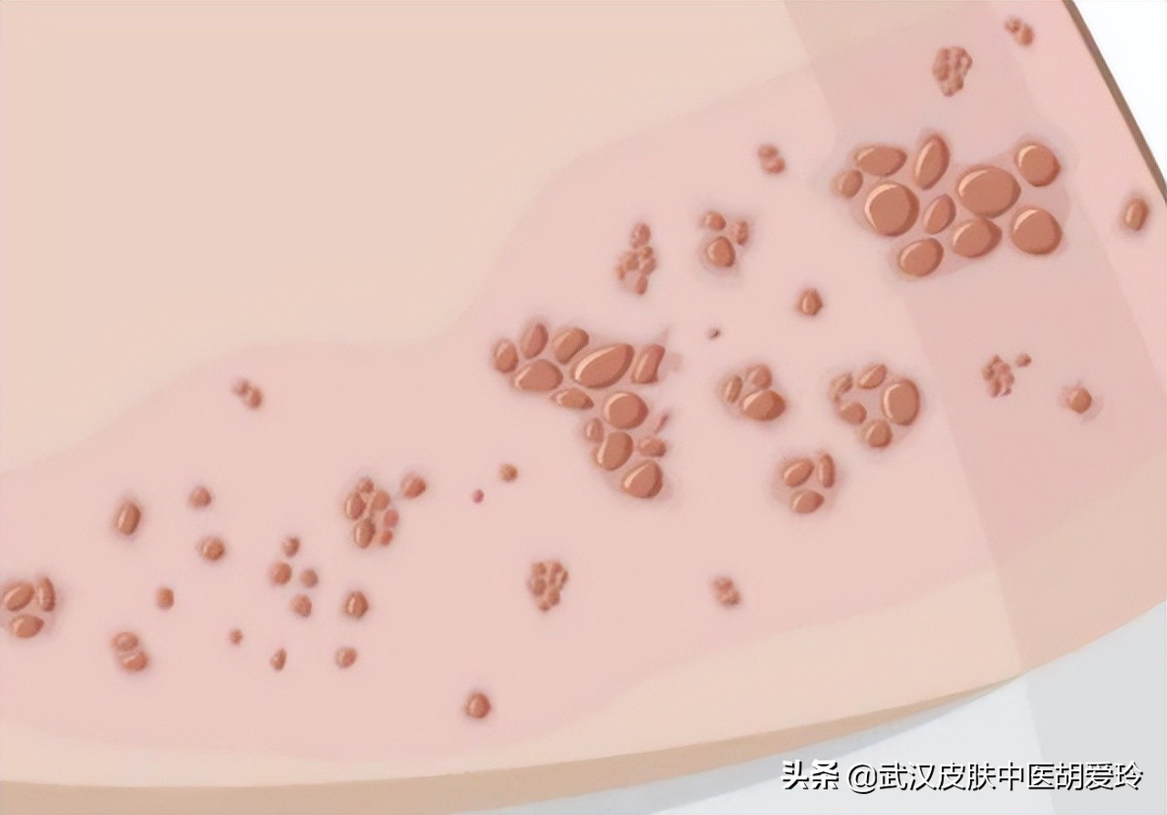 皮肤上有一块红了上面有很多水泡,皮肤上长了小水泡很痛怎么回事