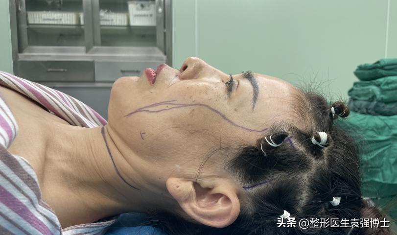 做大拉皮真的显年轻几岁吗,北京做大拉皮前后对比照片图文