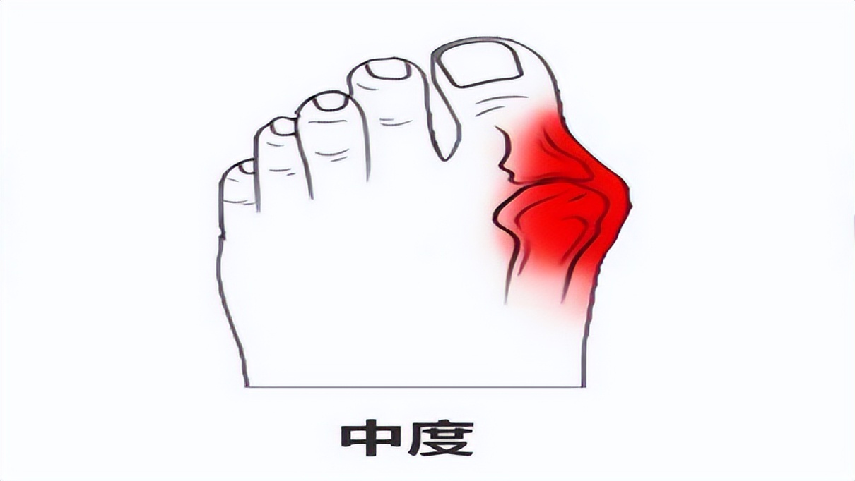 大拇脚趾往里歪怎么矫正,严重拇外翻脚趾畸形怎么办