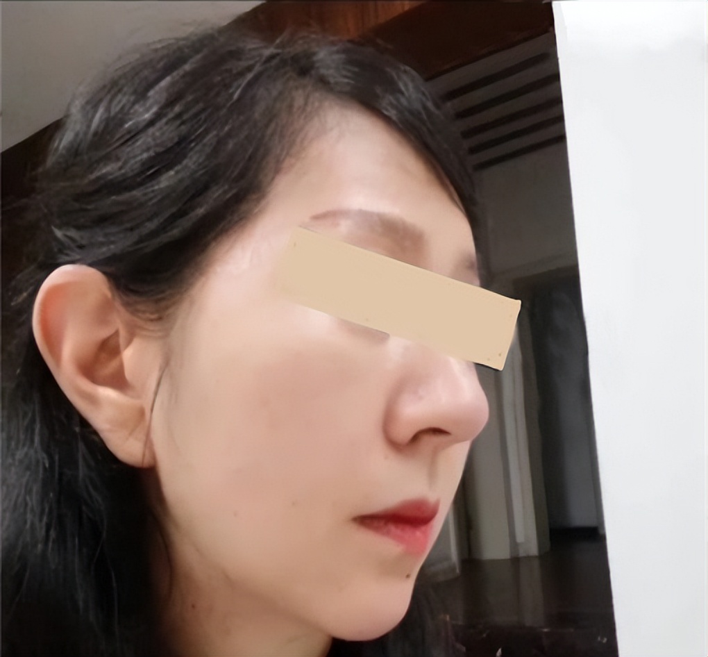 轮廓线打造和吸脂,面部轮廓线吸脂