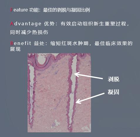 plasma和点阵激光祛痘坑哪个好,点阵激光仪去痘坑前后对比