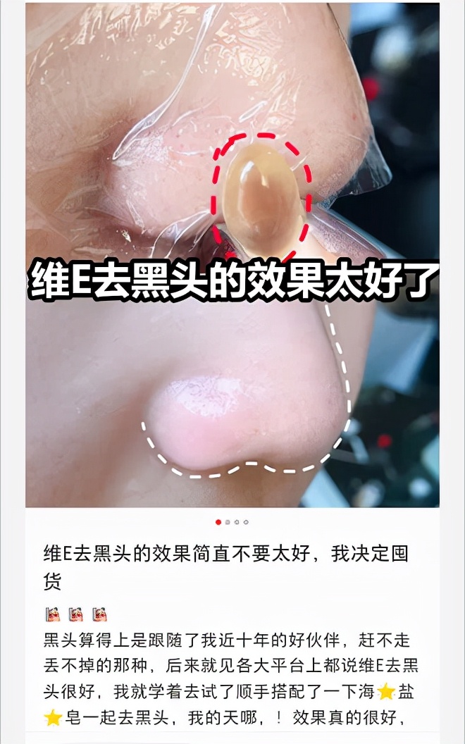 维e乳和维a酸乳膏怎么去黑头,抗氧祛痘去黑头