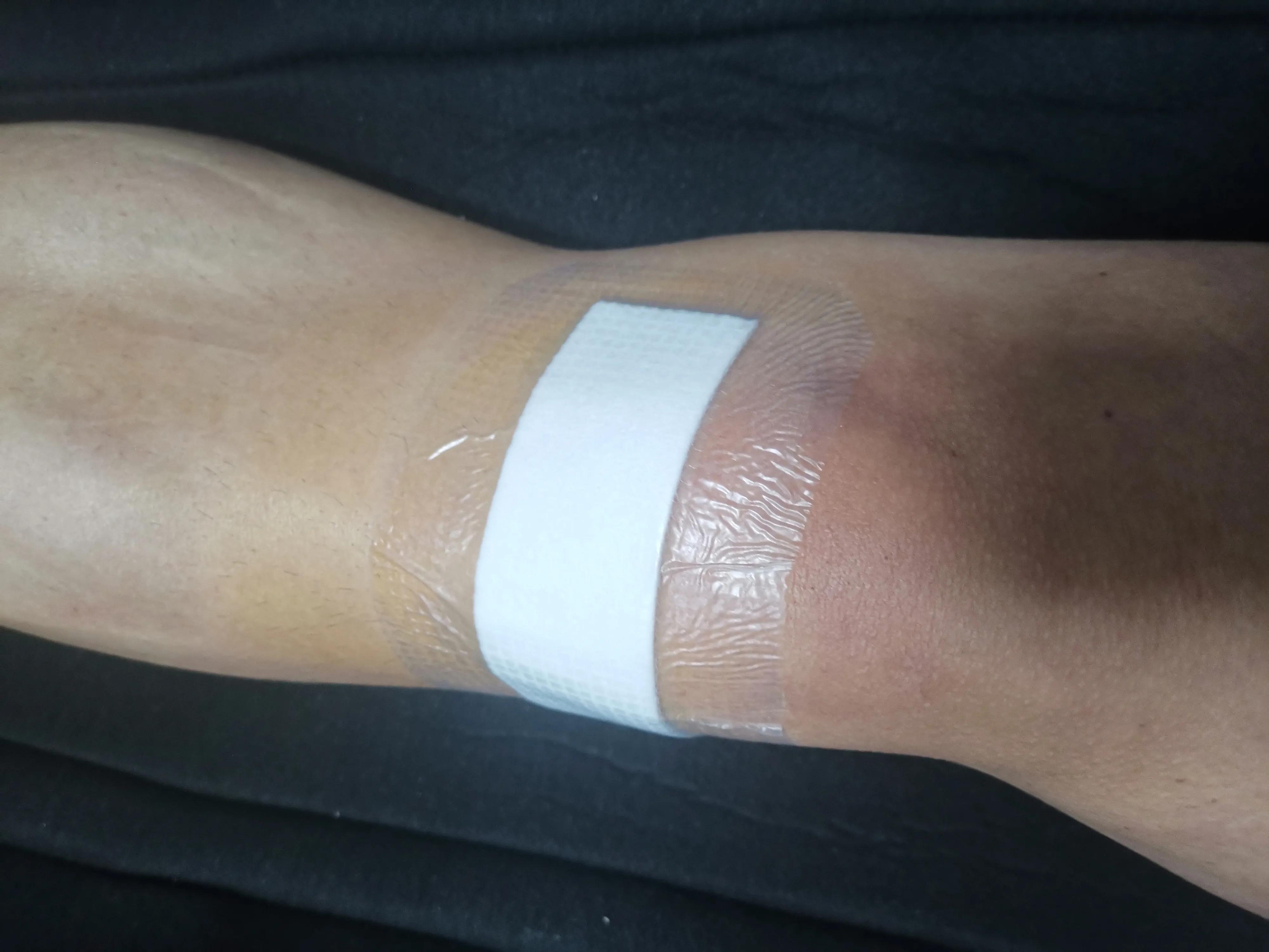 后角半月板撕裂微创手术,半月板撕裂微创手术沈阳