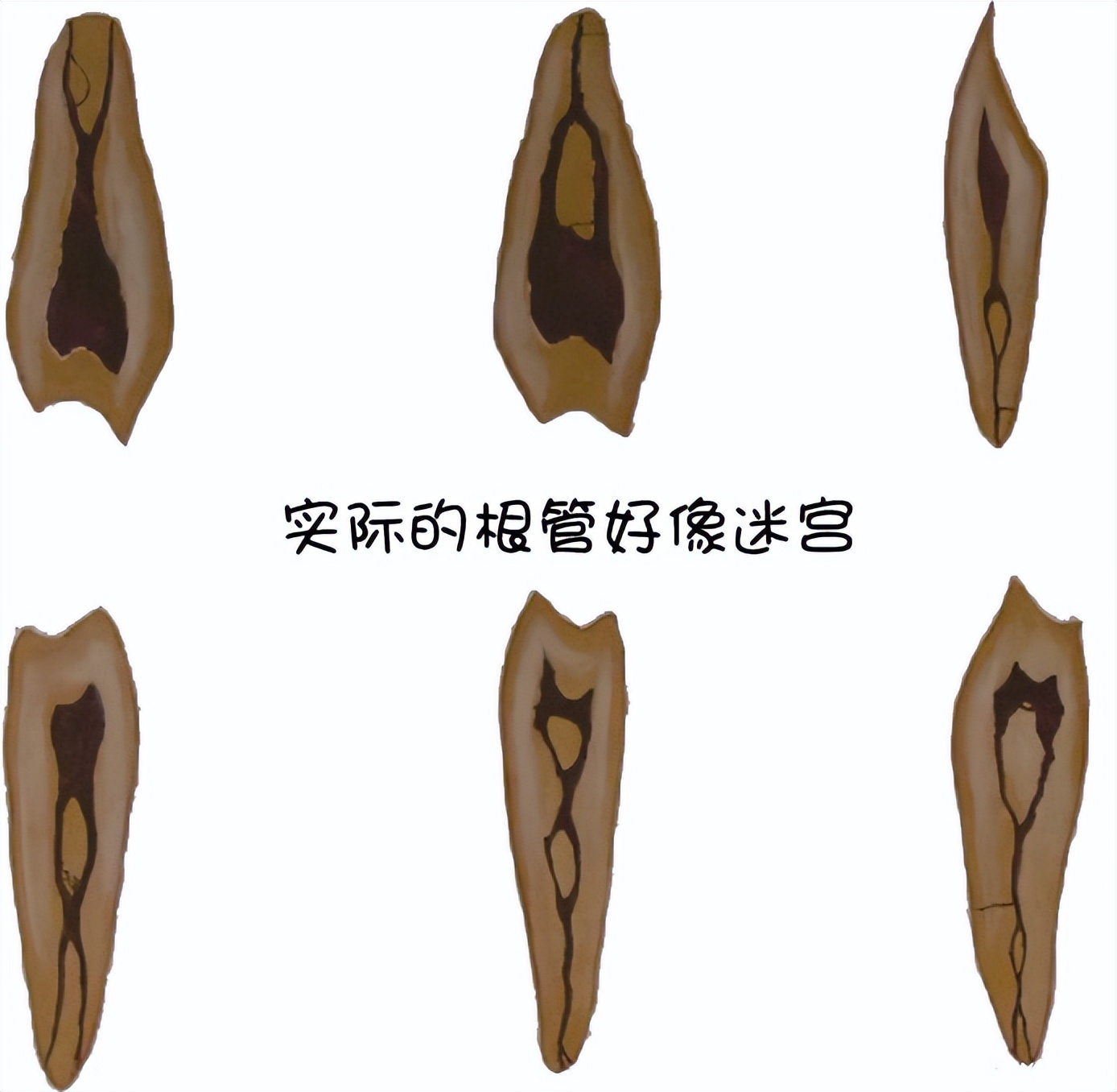 做根管治疗期间牙齿劈了,做根管治疗的牙断了一部分