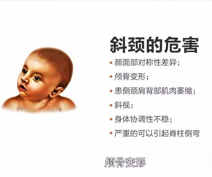 什么是斜颈呢,斜颈科普