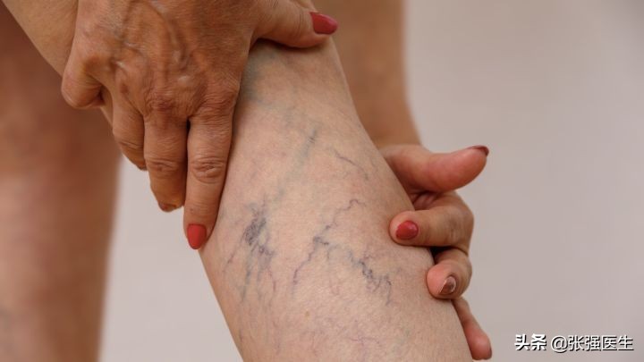 腿上出现蜘蛛网状血管怎么治疗,腿上蜘蛛状毛细血管是什么病