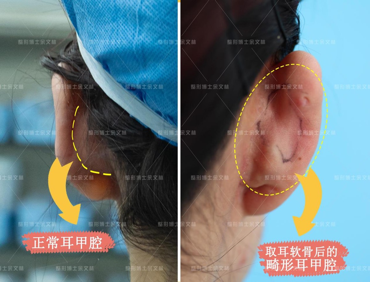 耳软骨隆鼻会塌下来吗,软骨隆鼻鼻小柱会塌吗